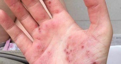 Young eczema sufferer who hid 'red crab claw' hands is now body-confident podcast host sharing flare-up photos on Instagram