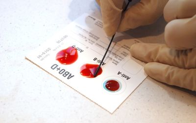 Blood type A linked to higher risk of stroke before the age of 60