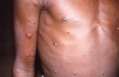 Second monkeypox strain linked with travel to West Africa identified in UK