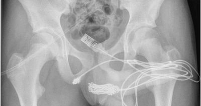 Teenage boy gets USB cable stuck in penis as doctors forced to surgically remove it