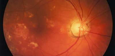 A window to the brain: the retina gives away signs of Alzheimer's disease and could help with early detection