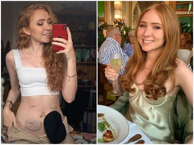 Woman who got a stoma bag at 25 says it has given her back her life