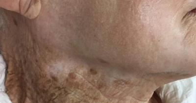 Woman's grim photo is stark warning to always apply sun cream on your neck