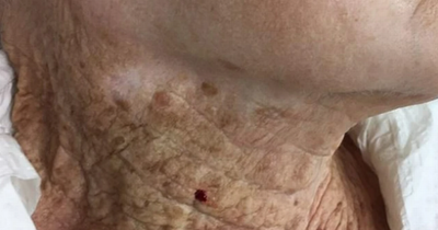 Grim photo of 92-year-old's neck is stark warning to always apply sun cream all over