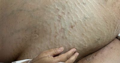 Woman dies after operation to have huge seven stone tumour removed from stomach