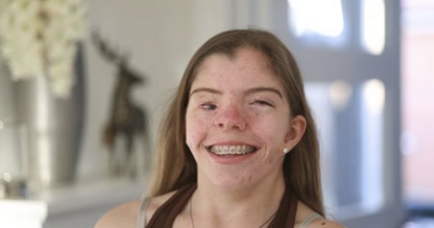 Woman born with rare condition 'pretends to be celebrity' to deal with people staring