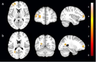 Study suggests fungal intruder shrinks, develops to aid infection spread in brain