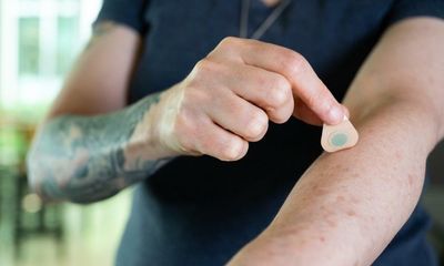 Microneedle tattoo technique could make tattooing painless and fast