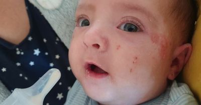 Parents scared to cuddle baby son in 'excruciating pain' with 'Freddy Krueger' blisters