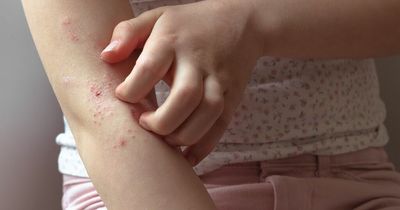 New drug could be available soon to help children suffering severe eczema