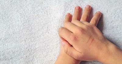 New drug treatment for eczema is 'highly effective' trials show