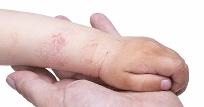 'It will revolutionise clinical practice worldwide' - breakthrough in treatment of eczema announced
