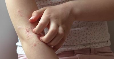 New eczema drug therapy 'highly effective' for young children