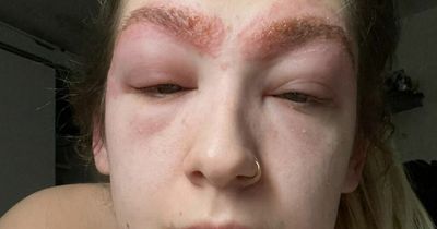 Mum hospitalised after horrific reaction to getting eyebrows tinted at Superdrug