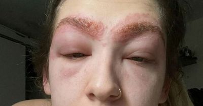 Mum rushed to hospital after horror allergic reaction to Superdrug eyebrow tint