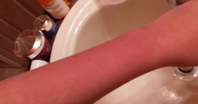 Teen's rare allergy leaves her feeling like she is being 'set on fire' and she can't cry as water gives her hives