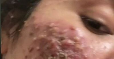 Woman with severe acne shares incredible transformation after treatment with TikTok fans stunned