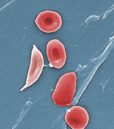 Study: Too few kids with sickle cell get stroke screen, care