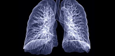 COVID-19 can cause lasting lung damage – 3 ways long COVID patients' respiration can suffer