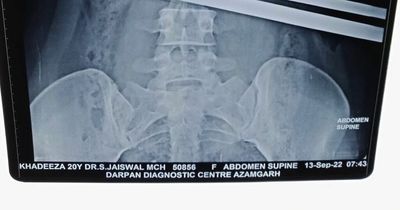 Woman impaled by steel rod after plummeting 22 feet during monkey attack