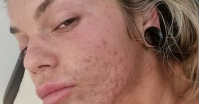 Woman cures painful acne by making simple diet switch that has 'changed her life'