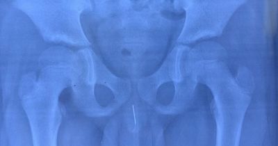 Doctor's stunned after painful discovery during X-ray of boy's penis