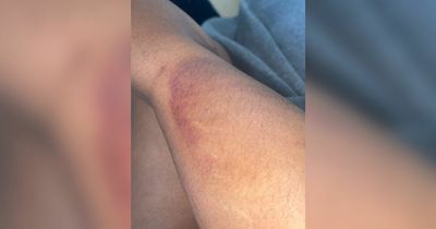 Woman's 'heart sank' as she looked at bruise on leg