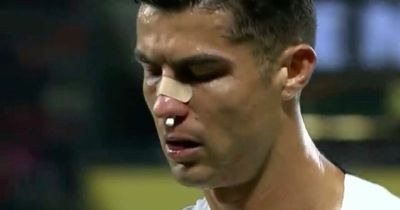 Cristiano Ronaldo's face left a bloodied mess after nasty collision on Portugal duty