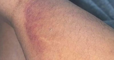 Woman spiked with injection woke up to find large purple and green bruise on leg