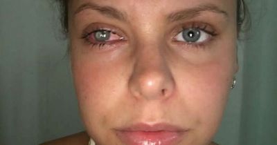 Personal trainer half-blinded after she got a bacterial infection from her dirty make-up bag