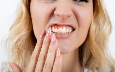 New dental gel treats gum disease by stopping inflammation