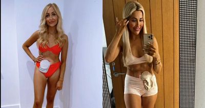 Confident bikini babe Holly shows off stoma bag after having colon and rectum removed