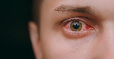 Red eye: Five common causes and when you should call 999