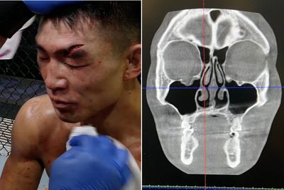 UFC’s Song Yadong posts X-ray of fractured orbital from Cory Sandhagen fight: ‘I was seeing triple’