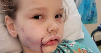 Girl, 7, left scarred for life after horror dog attack as her lip and cheek torn off