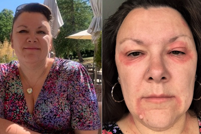 Woman whose eczema made her ‘look like a vampire’ praises ‘miracle’ cream