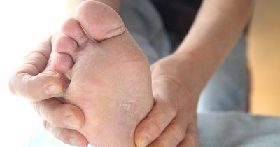 Type 2 diabetes early symptoms found on the elbows, feet and hands you should never ignore