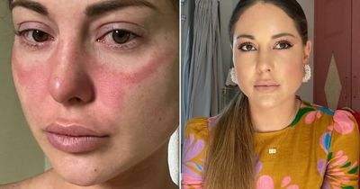 Louise Thompson shares 'horrendous' rash and feels 'immune system is attacking my face'