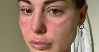 Louise Thompson shares worrying health update after posting snap of severe facial rash