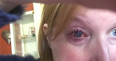 Woman, 54, lost eye after wearing contact lens in shower