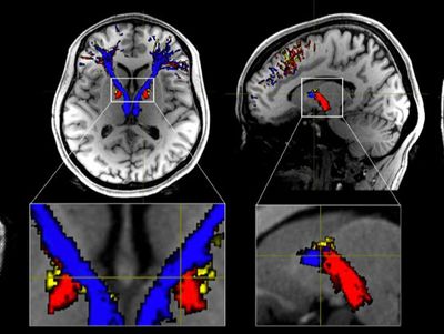 Scientists discover why heroin is addictive