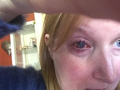Woman loses eye after it became infected while she was having a shower