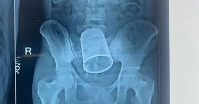 Doctors find and remove steel cup from inside man’s body
