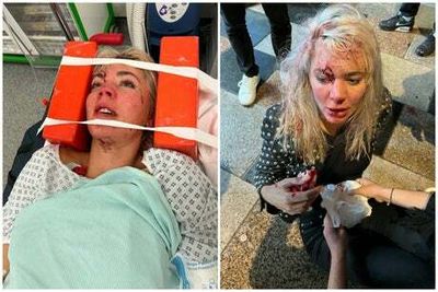A Place in the Sun star left with horrific facial injuries after being hit by moped in London