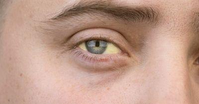 Pancreatic cancer symptoms you should never ignore - thirst to unusually dark urine