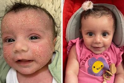 Mum says she has ‘completely different baby’ after £7.99 cream helped painful eczema