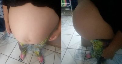 Woman denied abortion fears conjoined twins will be 'lifeless' after painful pregnancy