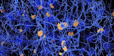 Alzheimer's disease: surprising new theory about what might cause it