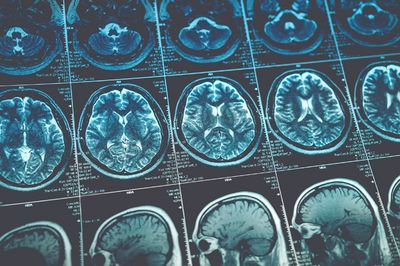 Alzheimer's may not be a brain disease