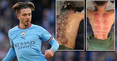 Man City's Jack Grealish shares images of 'hot cupping' treatment before Liverpool game